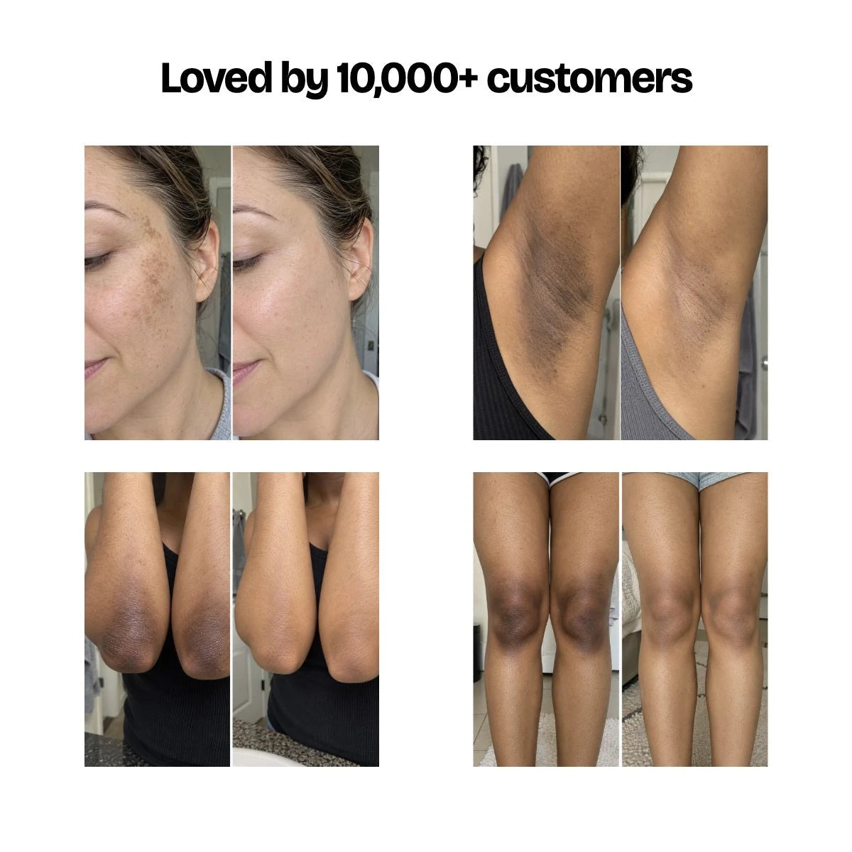 Loved by 10,000+ customers — face, underarms, elbows and knees
