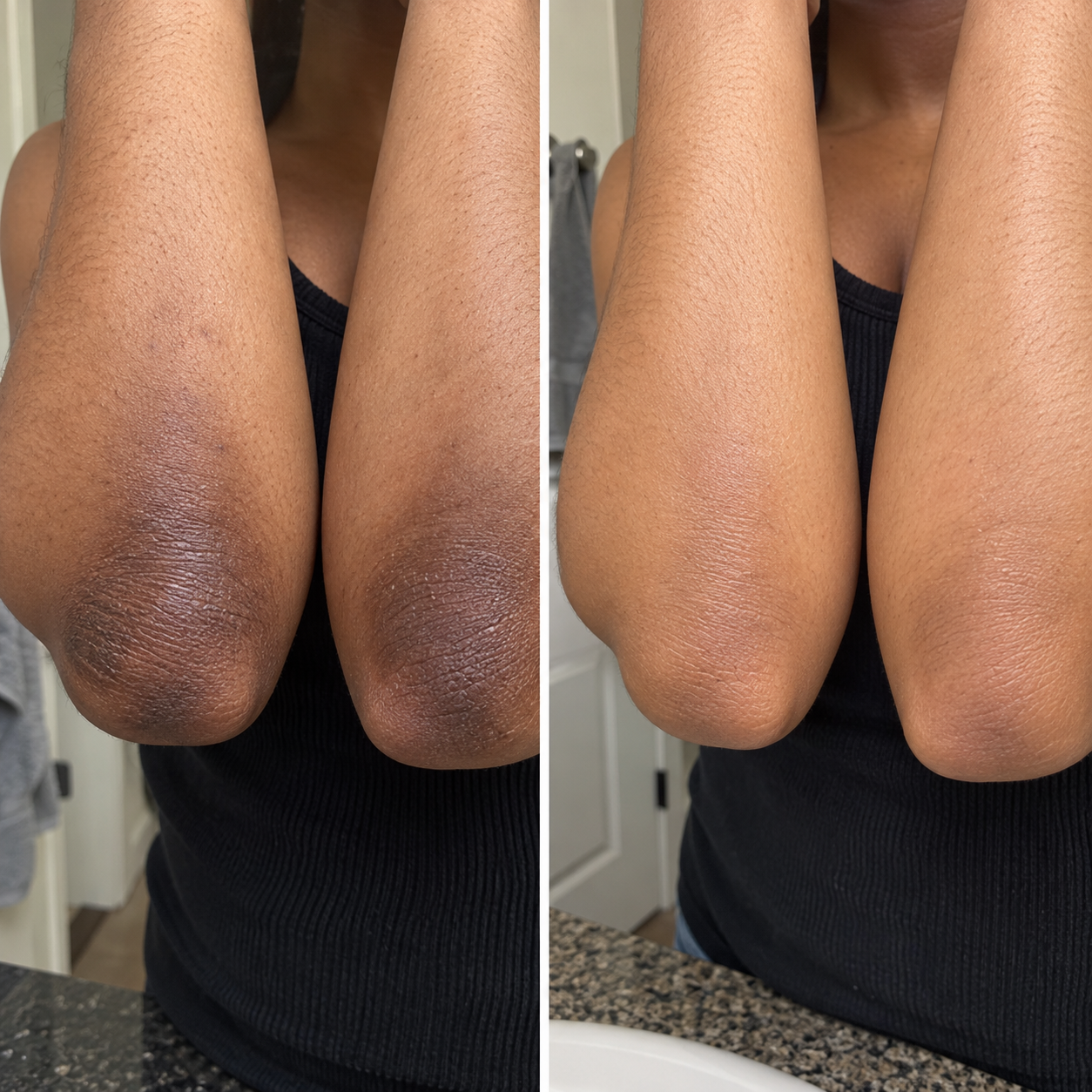 Customer before and after post acne marks on medium light skin